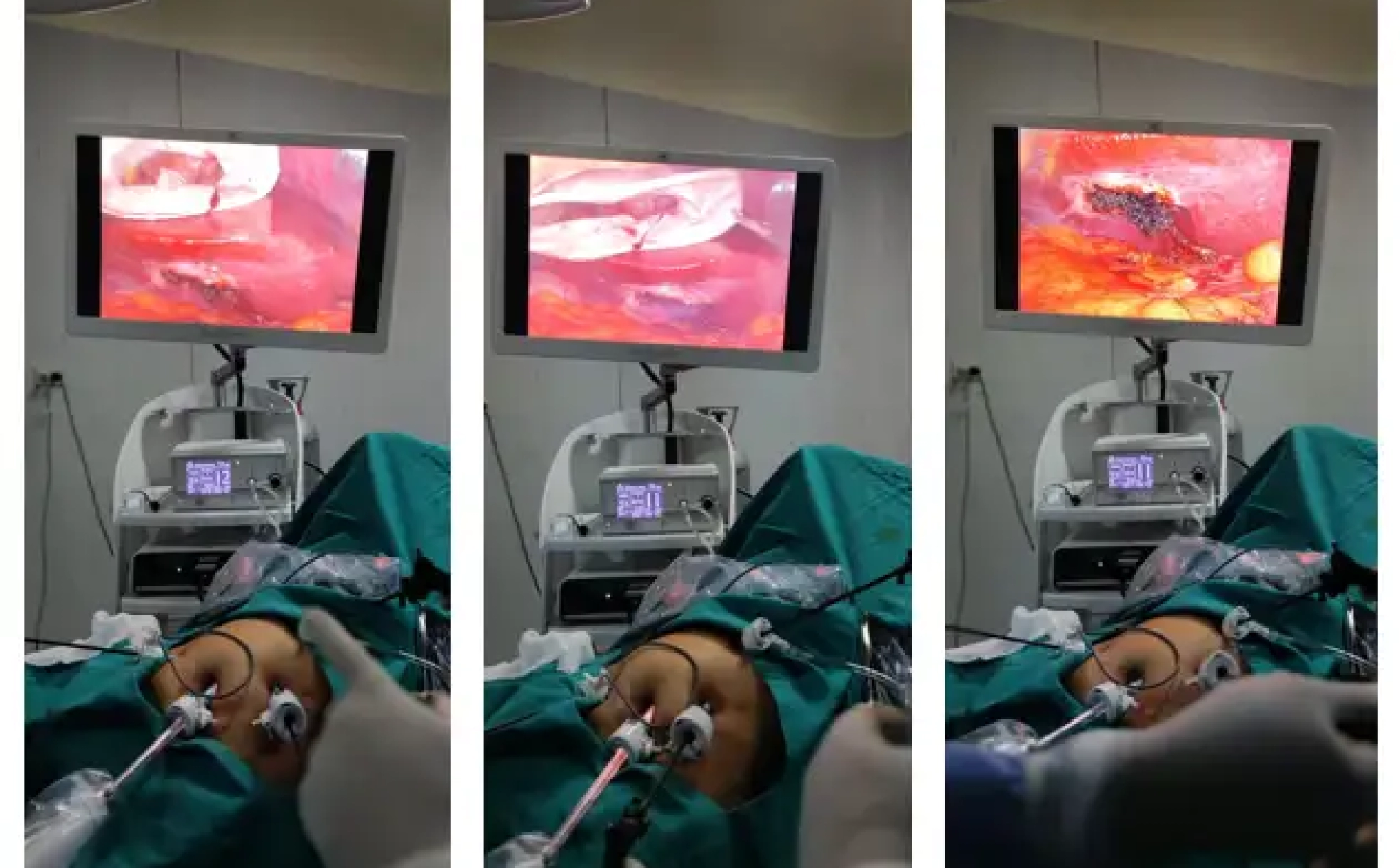 operaciones-com-torre-de-cirugia-marca-vims-hospital-espinar-cuzco